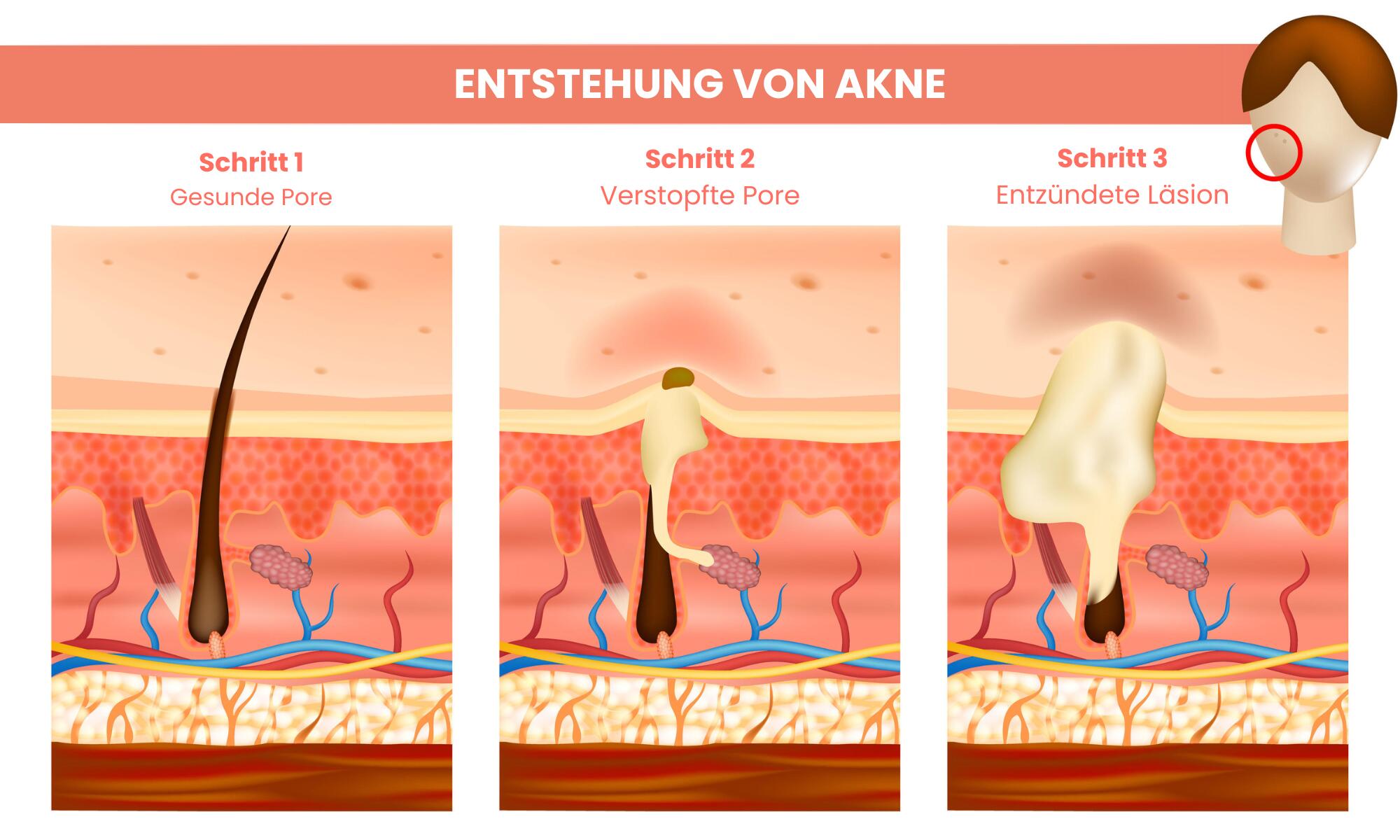 Die Infografik zeigt in drei Schritten, wie sich aus einer gesunden Hautpore über eine verstopfte Pore mit Talgansammlung eine entzündete Aknepustel entwickelt.